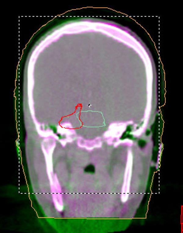 Elekta Synergy brian lesion CT scan