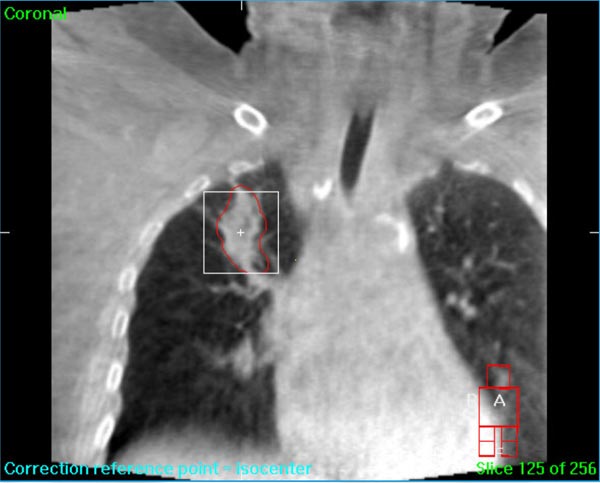 Elekta Synergy CT scan